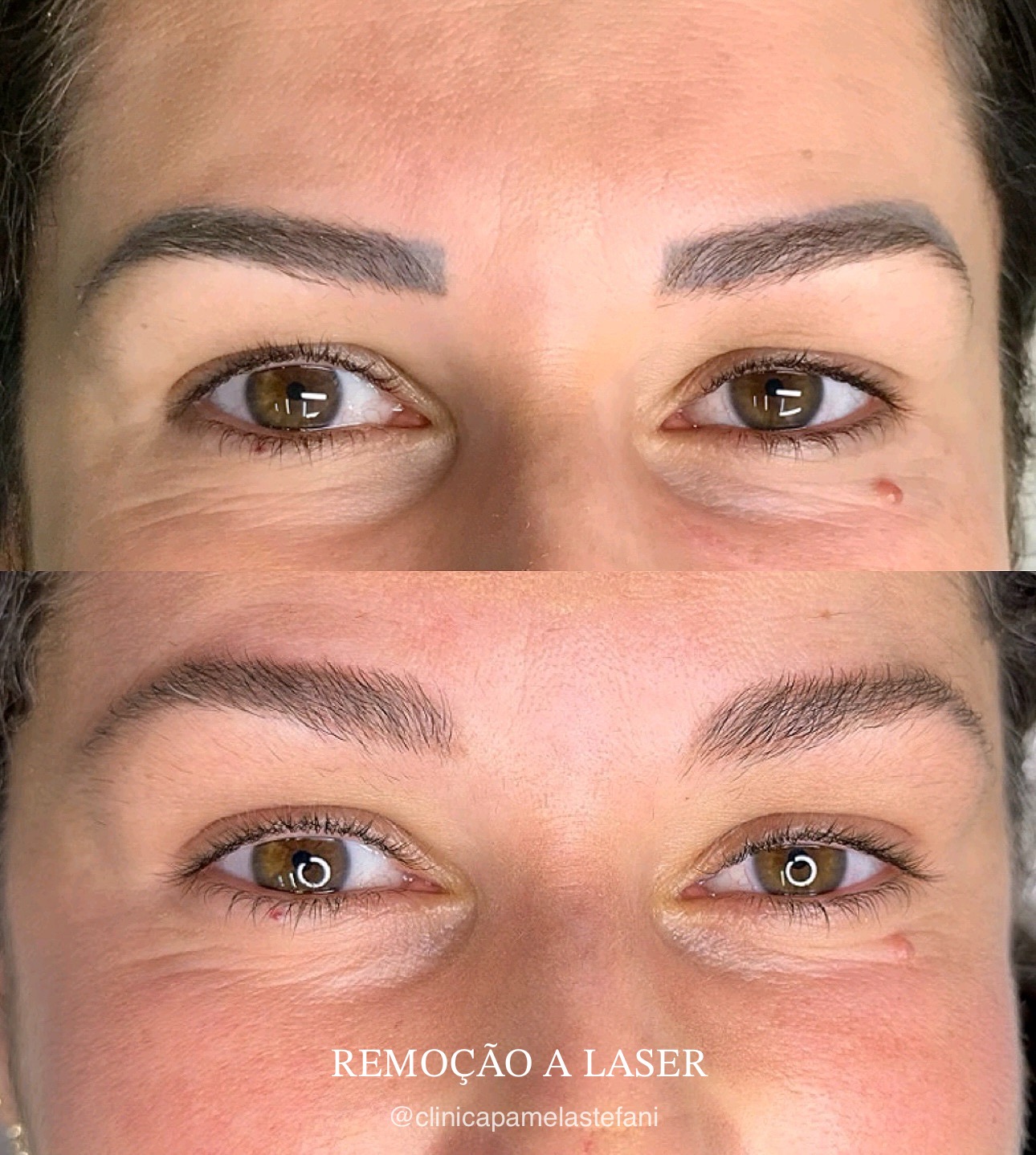 Antes e depois de remoção a laser de micropigmentação de sobrancelhas